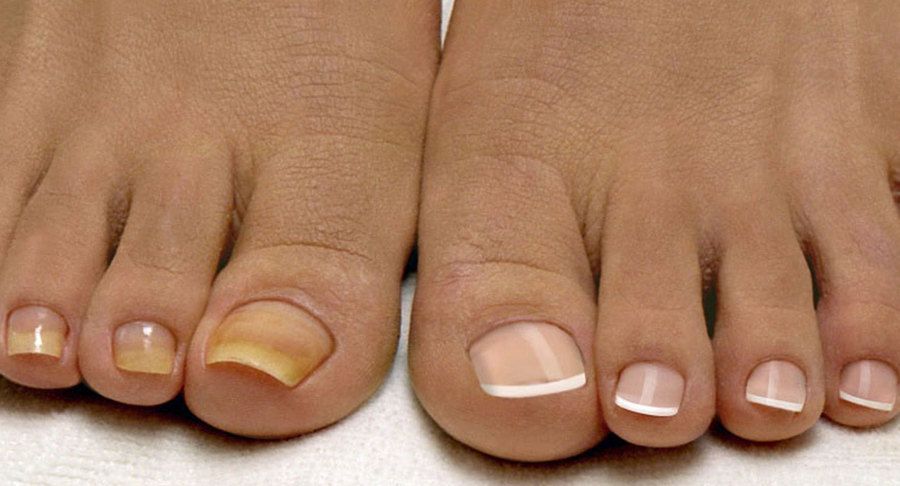 начальная стадия грибка ногтей  на ногах
